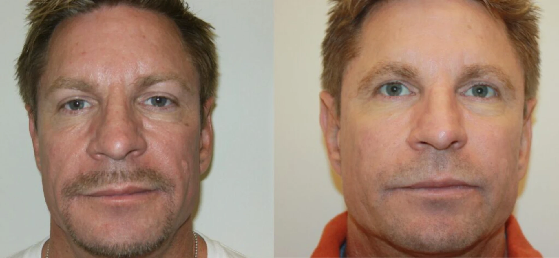 Wrinkle Reduction Park City