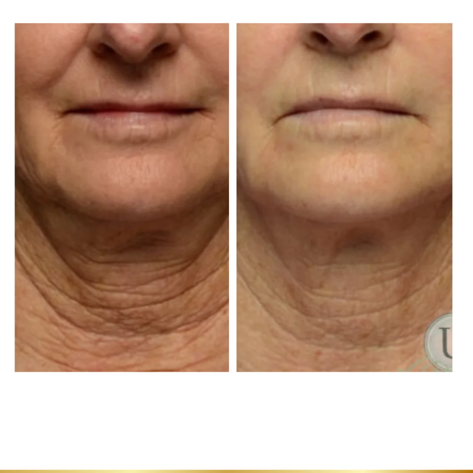 Before and after neck lift results showing tighter skin and reduced wrinkles