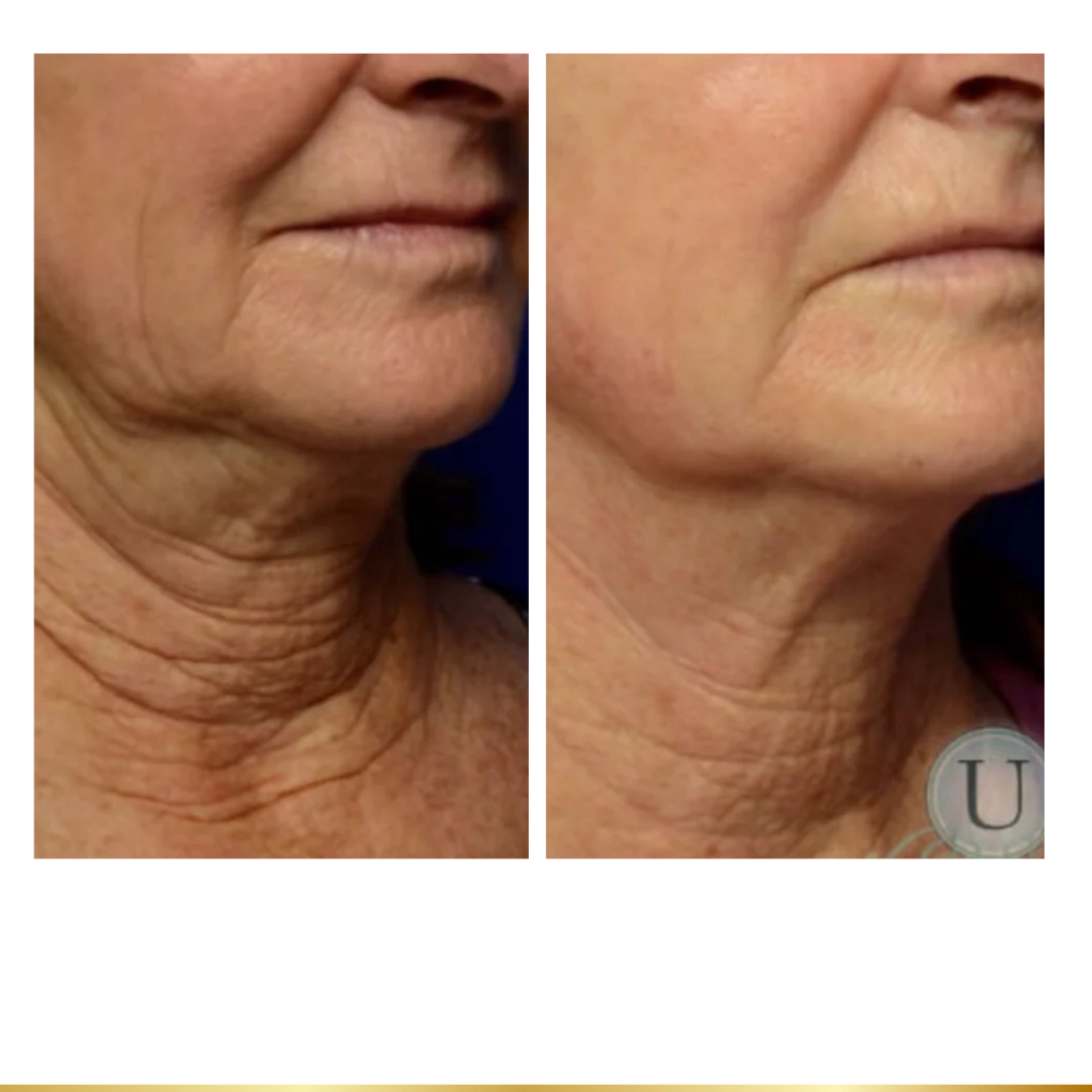 Before and after neck tightening treatment showing reduced wrinkles and firmer jawline definition.