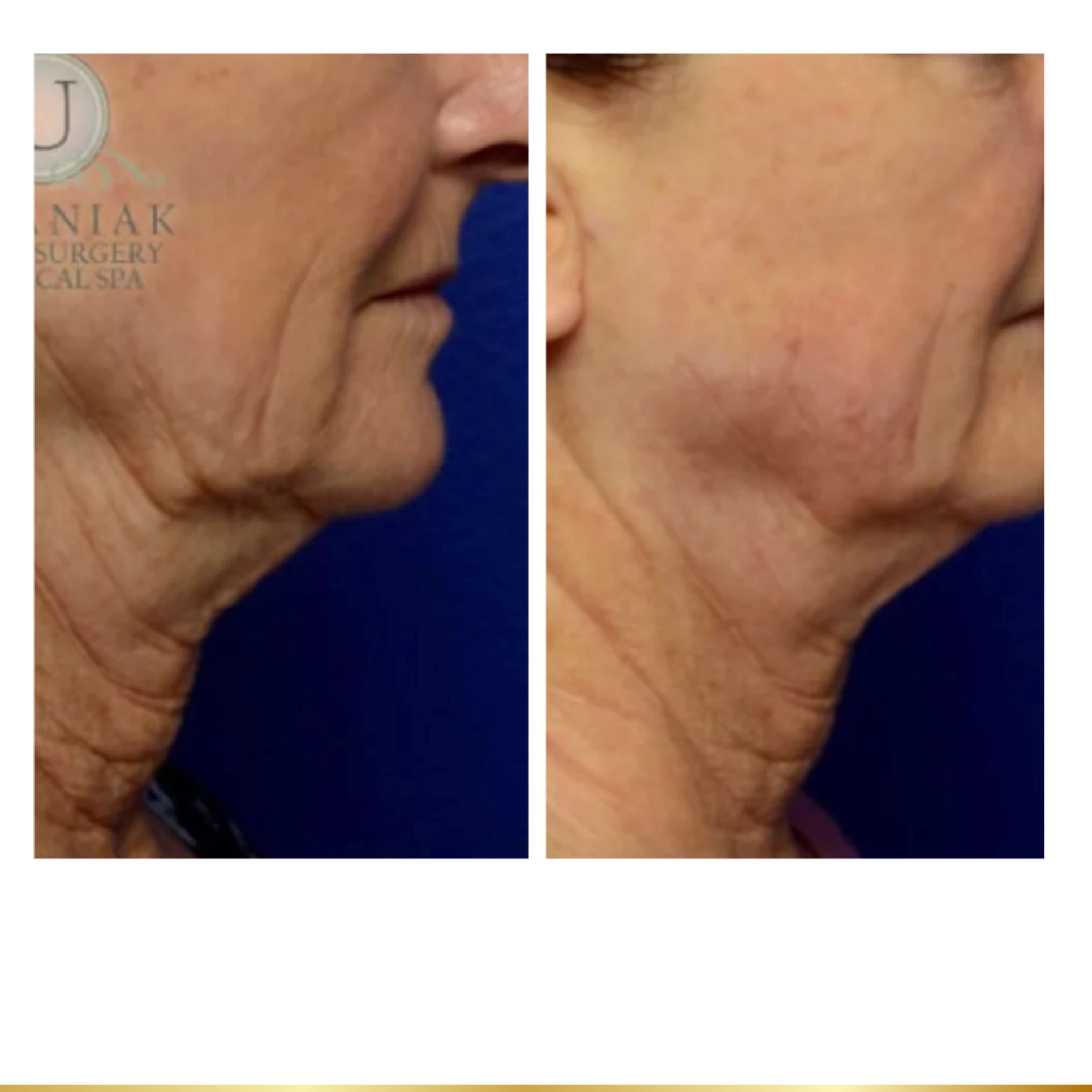 Before and after neck tightening and jawline contouring treatment