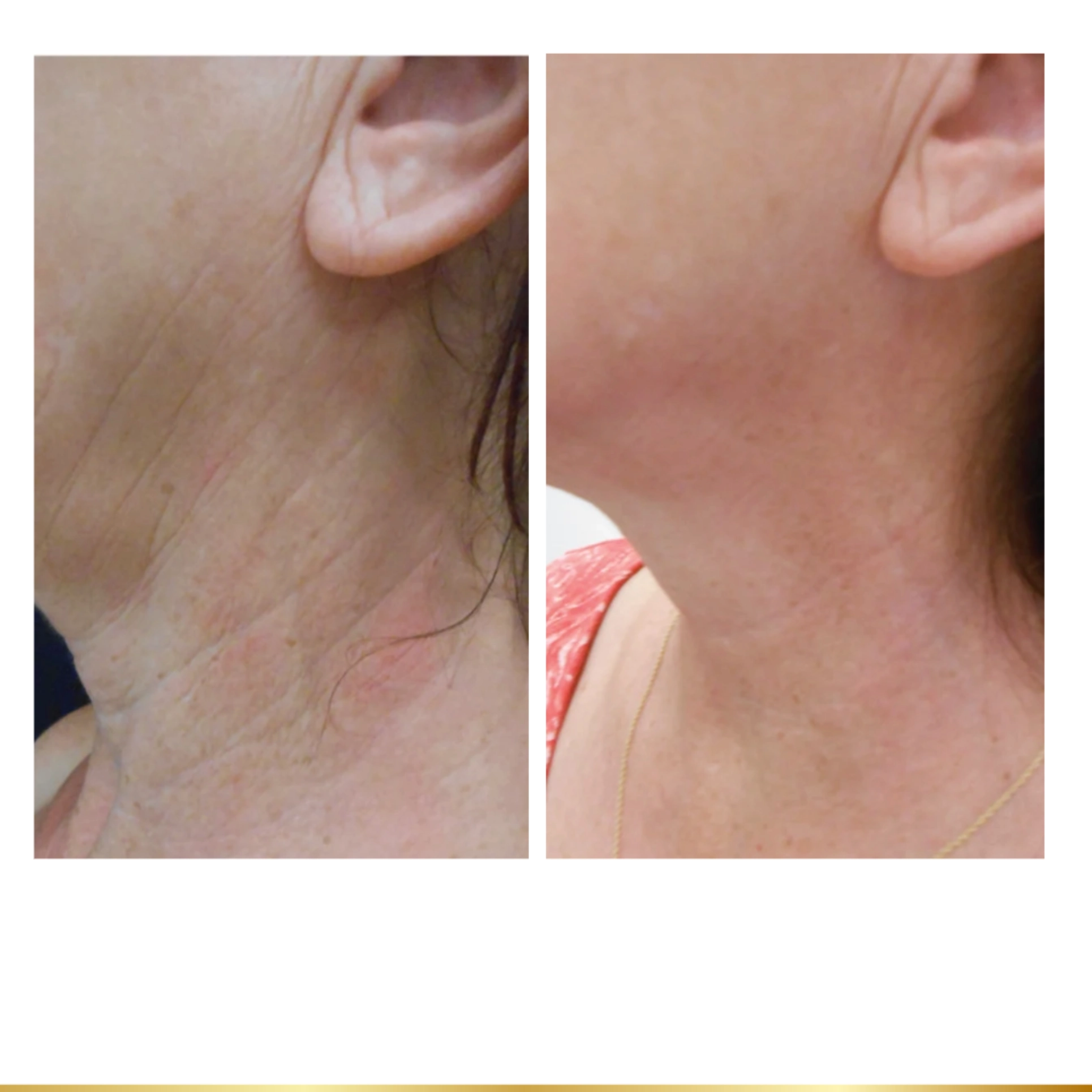 Before and after neck tightening showing reduced wrinkles and smoother, firmer skin under the jawline.