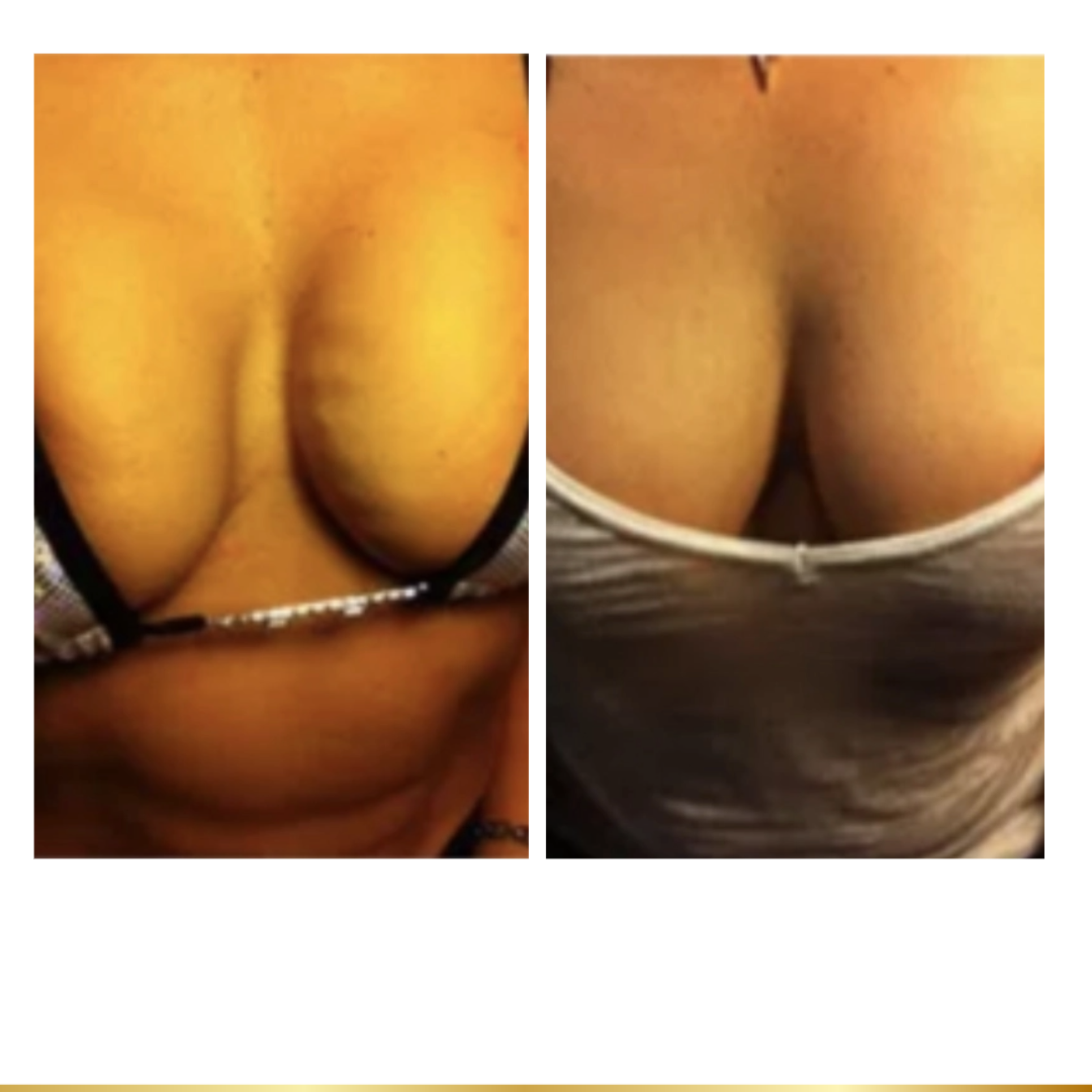 Before and after facial rejuvenation showing smoother skin, reduced under-eye bags, and lifted features