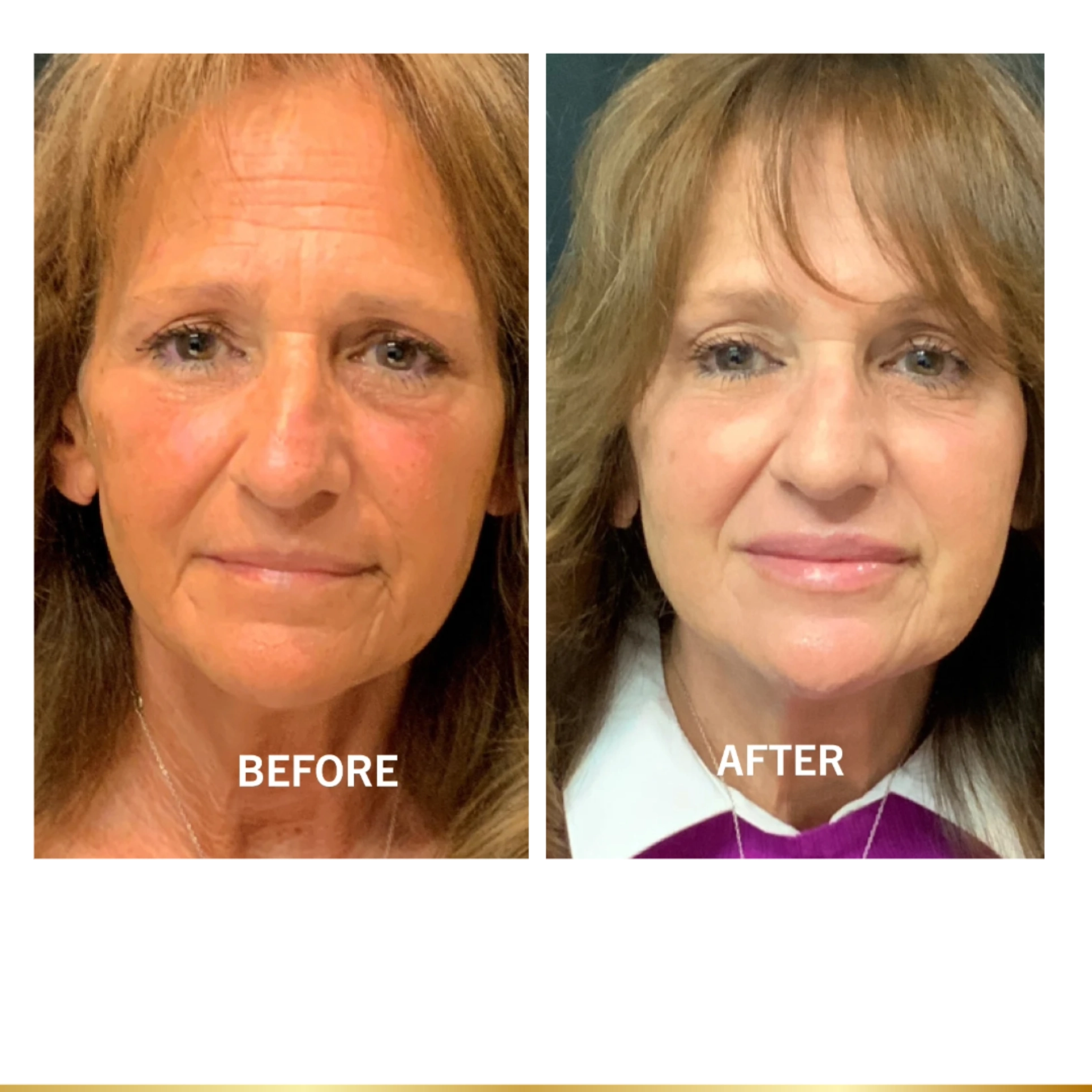Before and after facial rejuvenation on mature woman