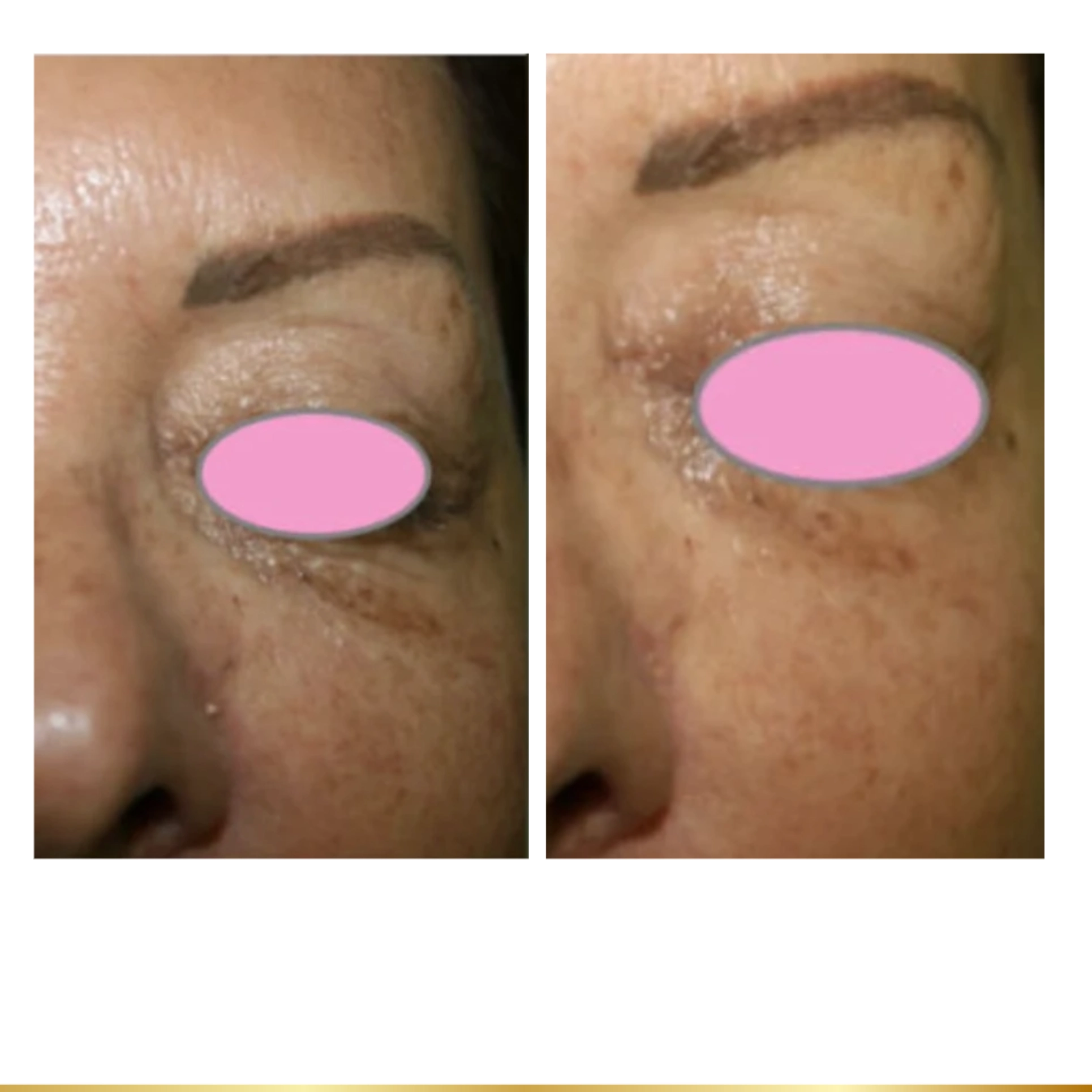 Under-eye wrinkle reduction before and after treatment results