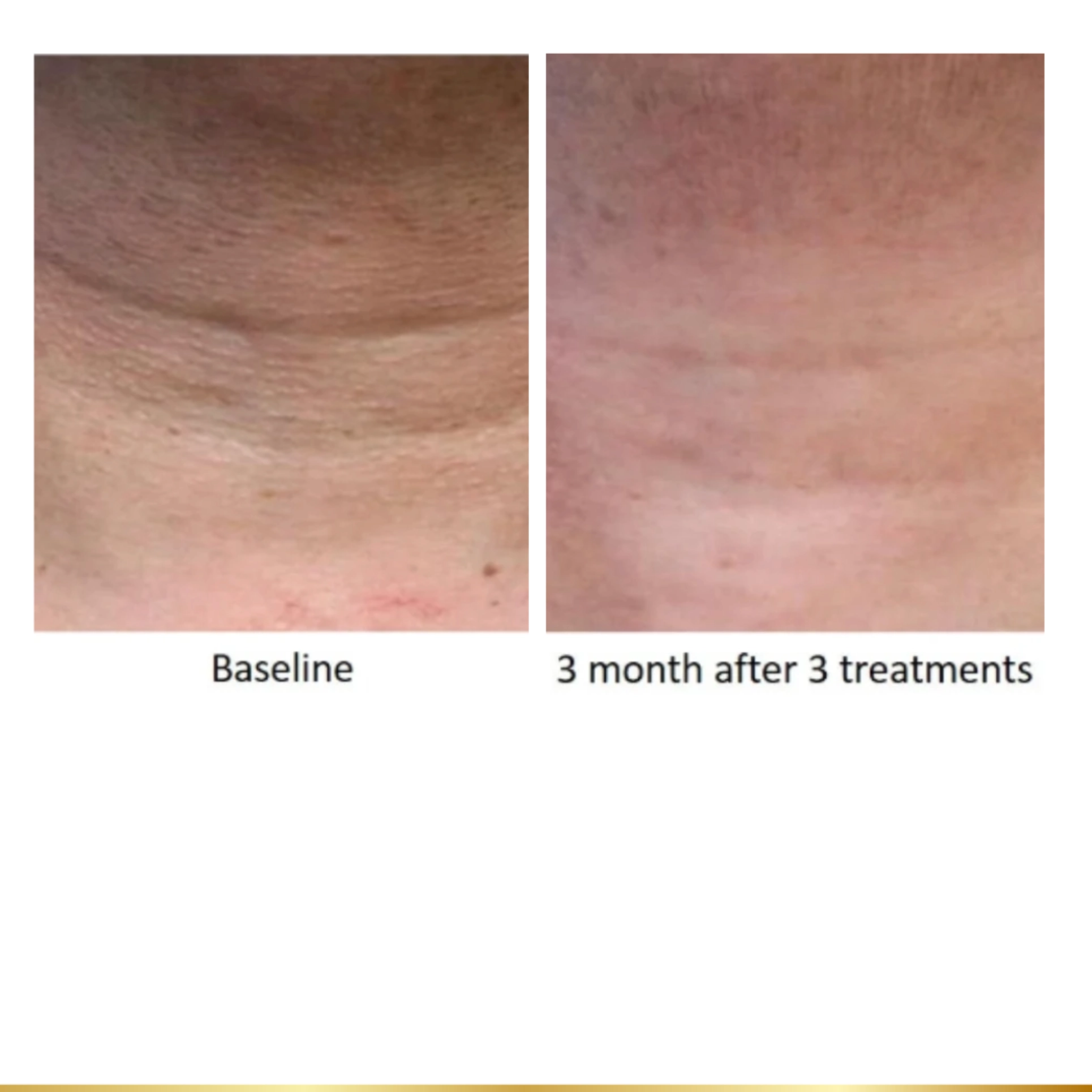 Neck skin before and after three treatments