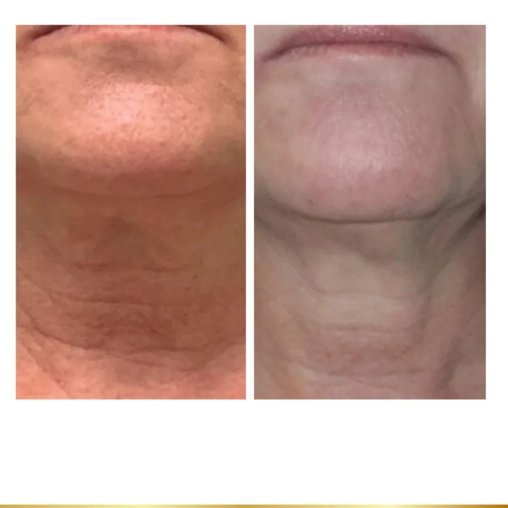 Before and after neck tightening showing smoother skin texture and reduced fine lines under the chin