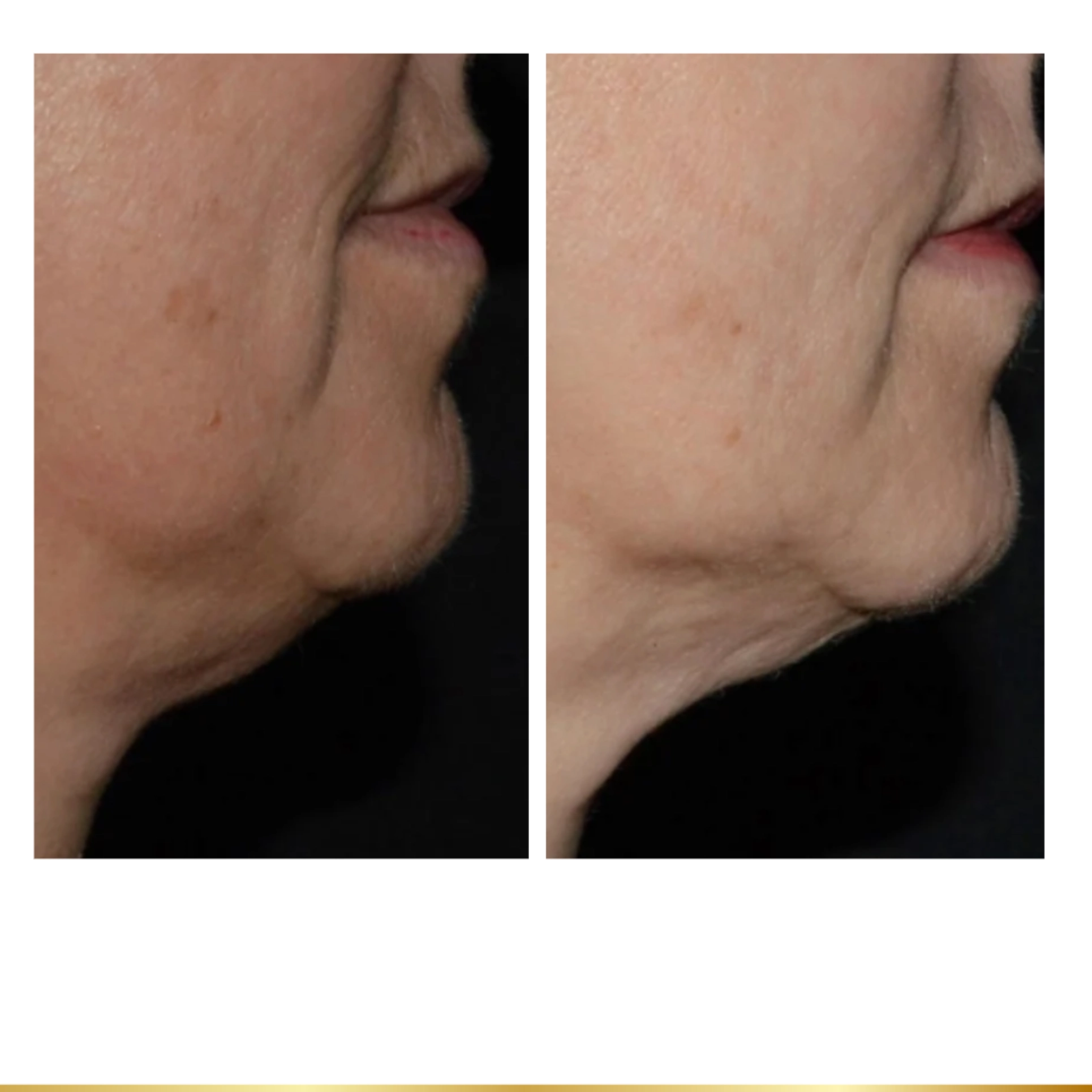 Before and after lower face treatment at Park City Medesthetix
