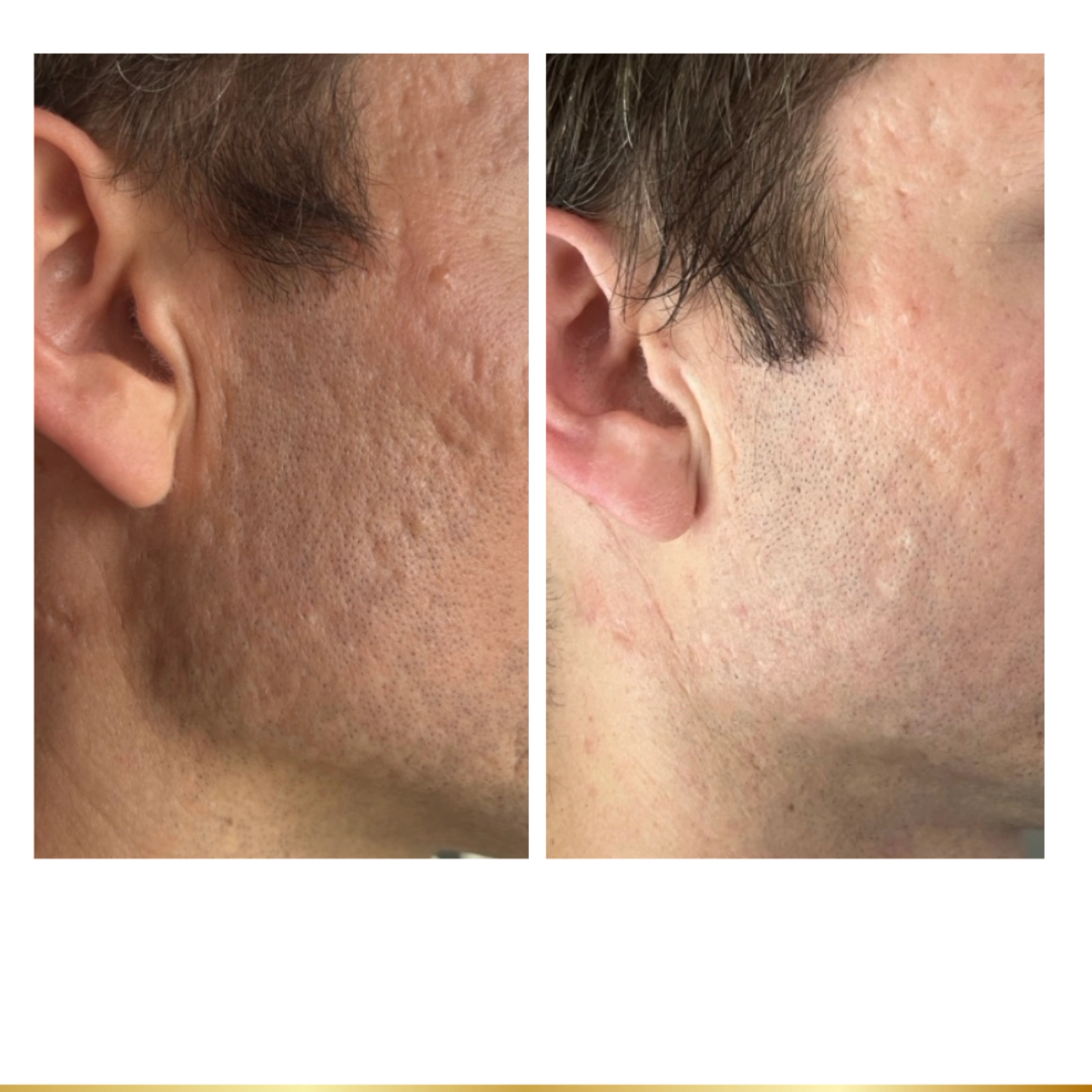 Acne scar reduction before and after skin resurfacing treatment