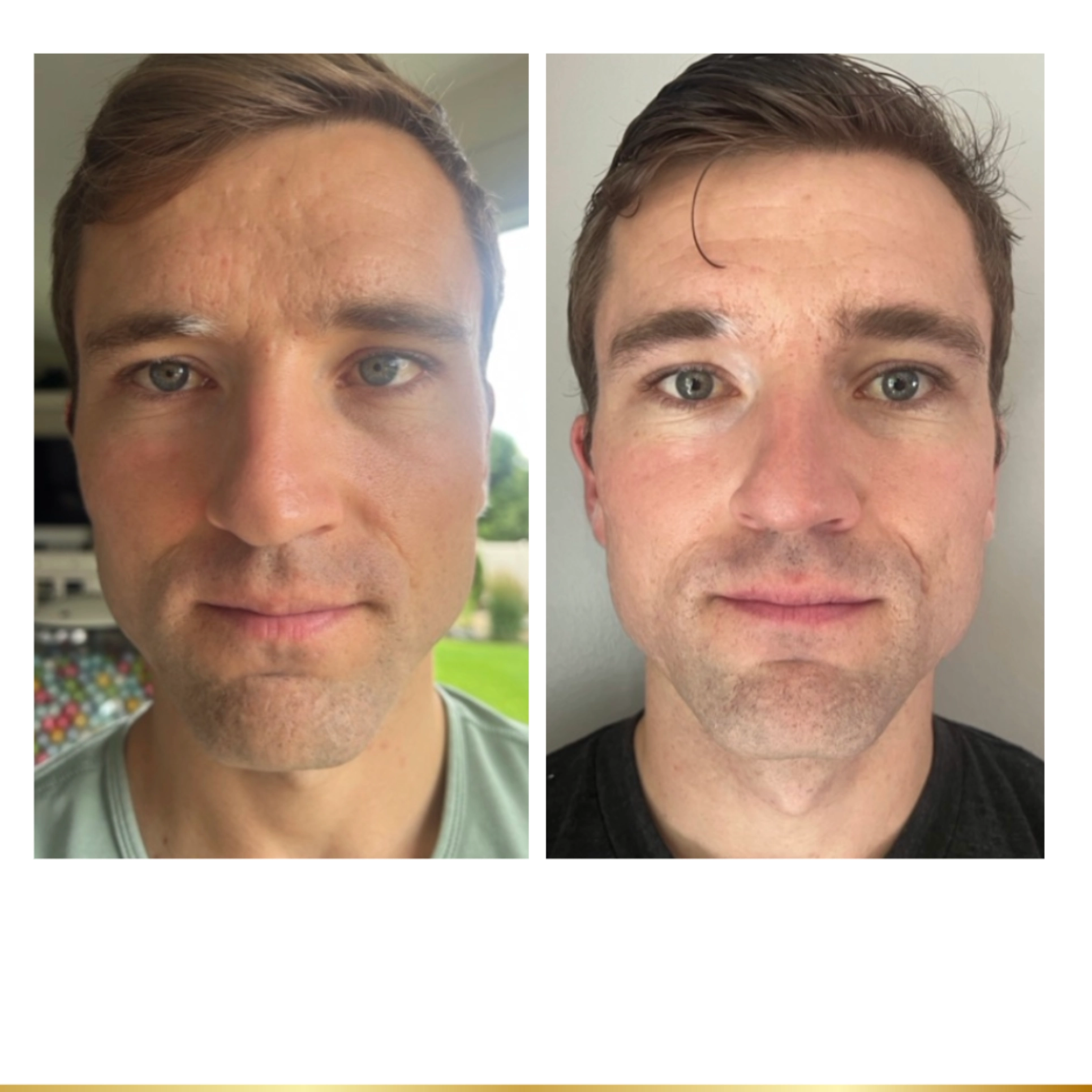 Before and after facial treatment showing improved skin tone, reduced blemishes, and refreshed look.