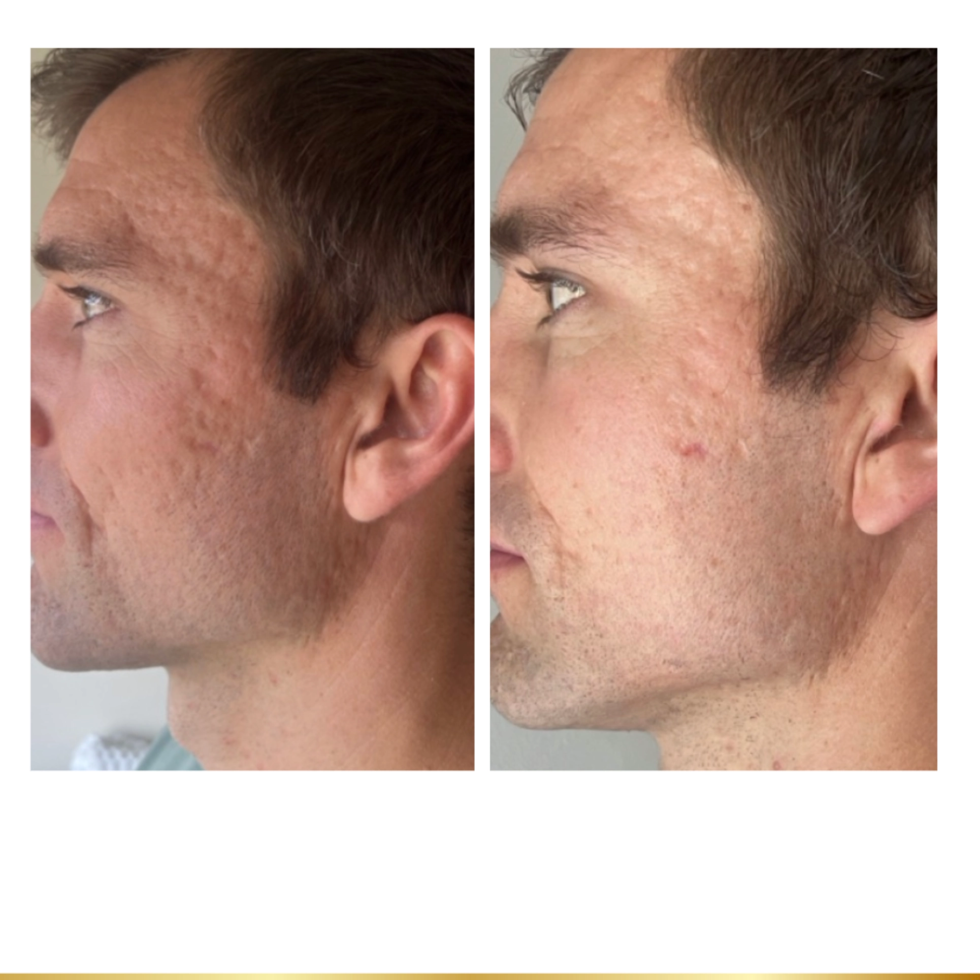 Male Genius RF Microneedling treatment before and after results