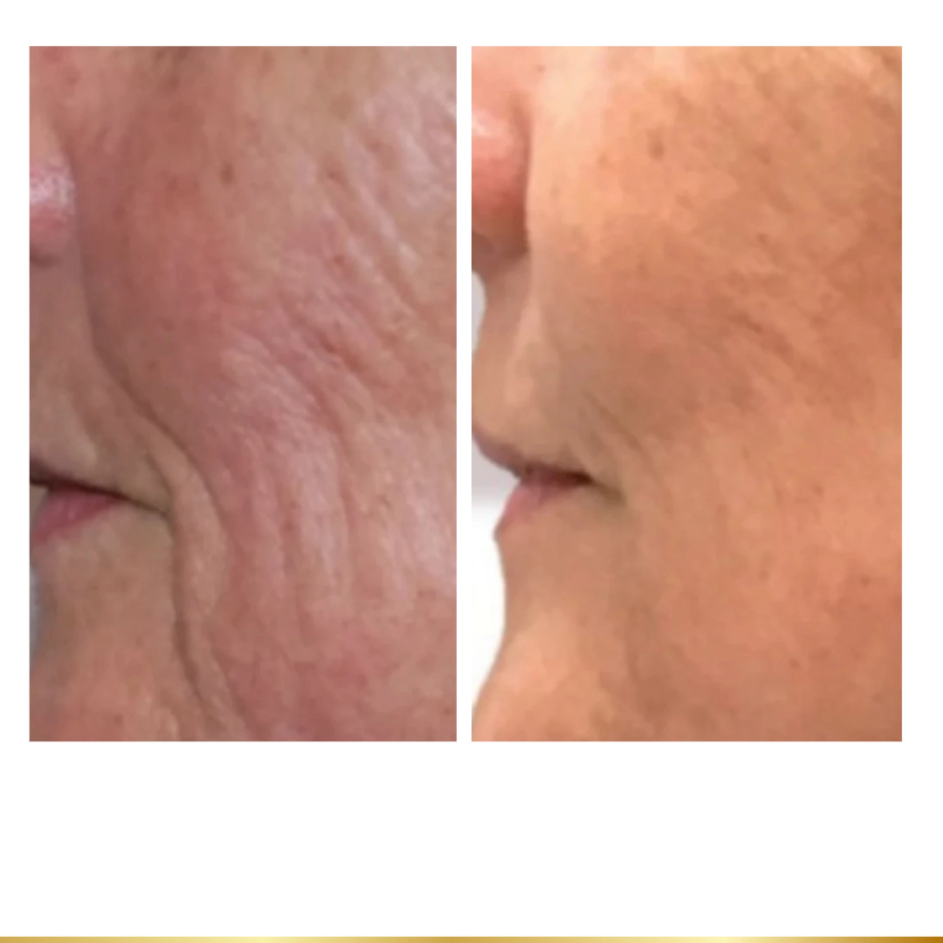 Before and after wrinkle reduction showing smoother skin texture and improved firmness around mouth.