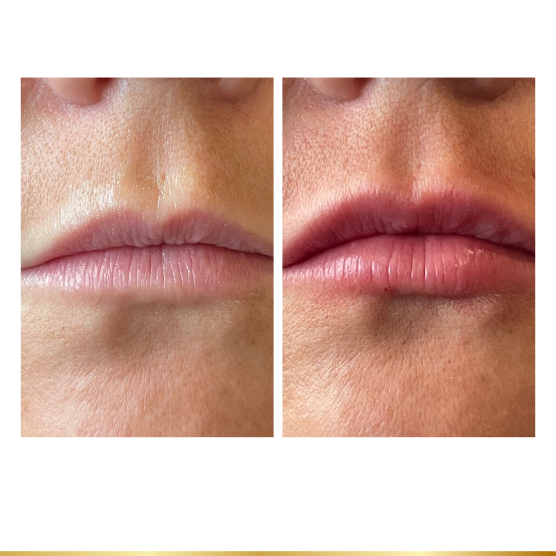 Lip filler results enhancing shape and definition at cosmetic clinic