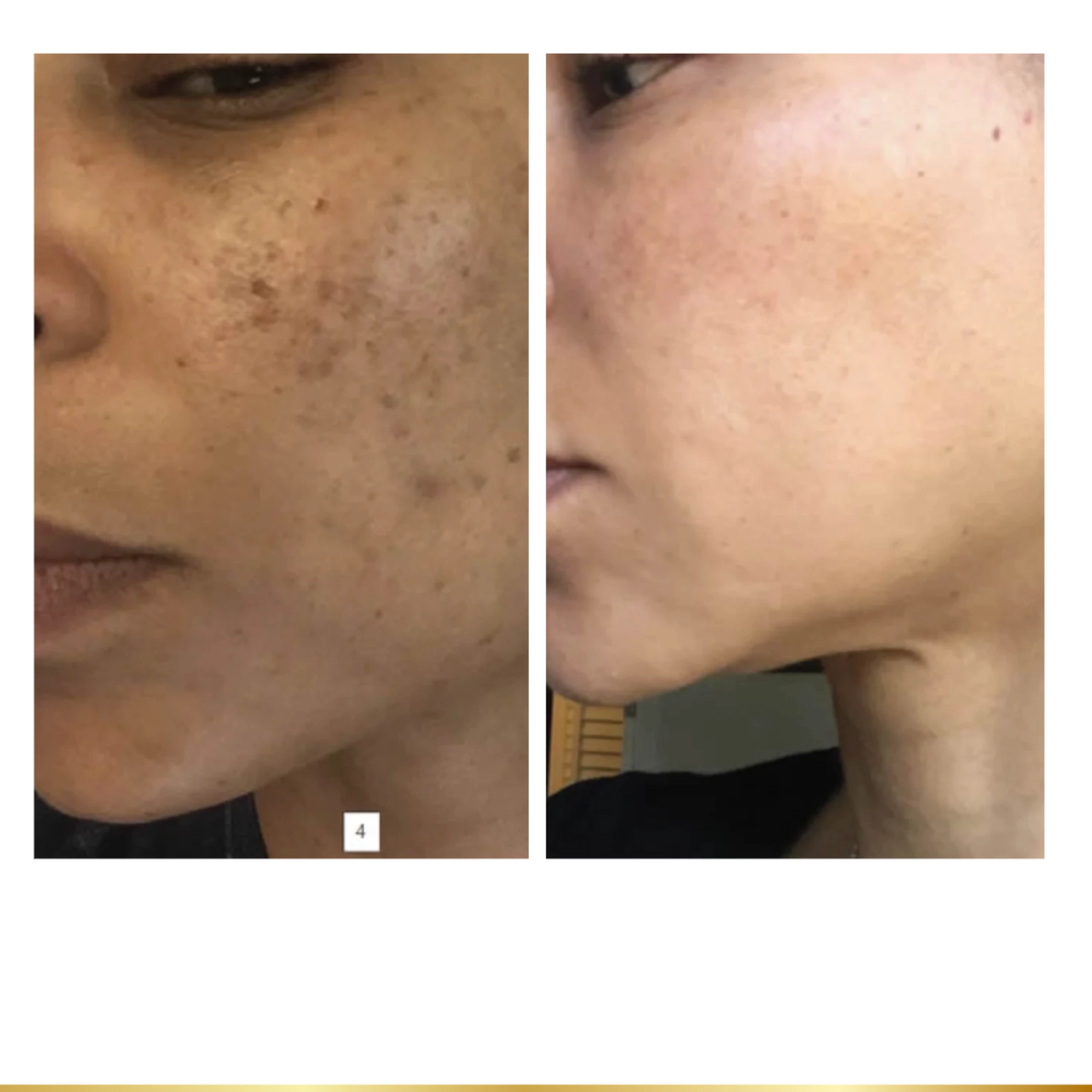 Before and after hyperpigmentation treatment on woman's cheek