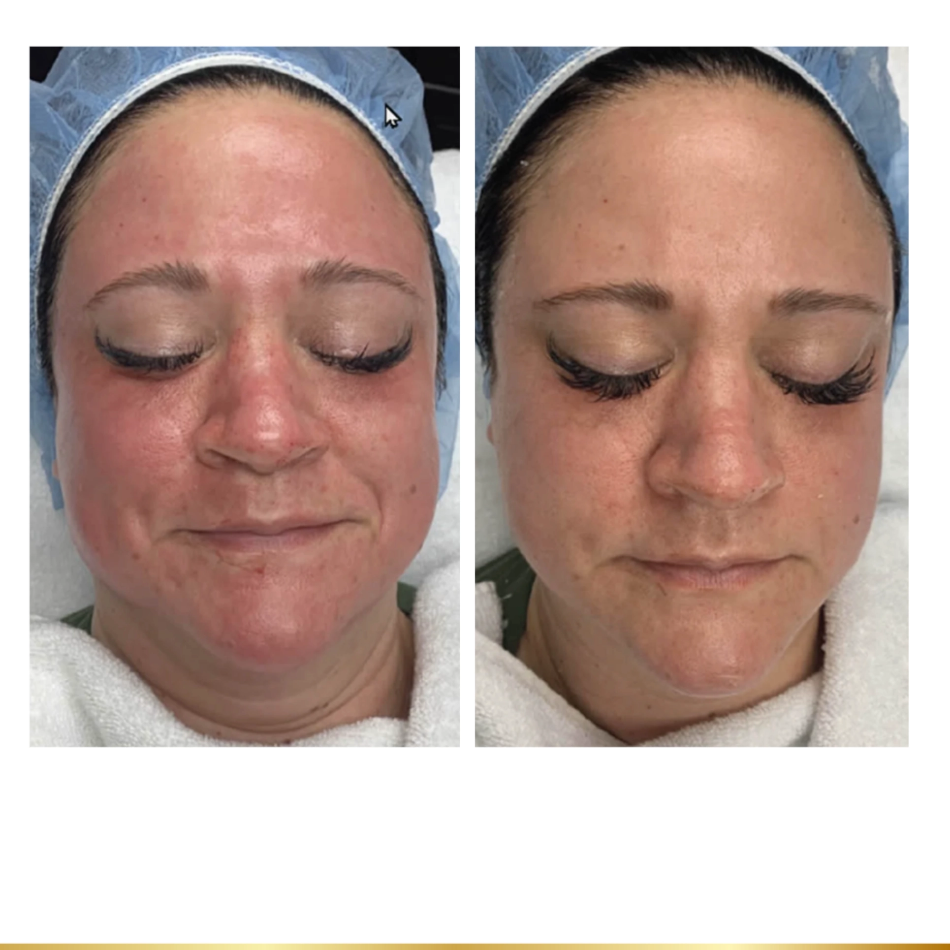 Facial treatment results highlighting calmer, more even skin and reduced post-procedure redness.