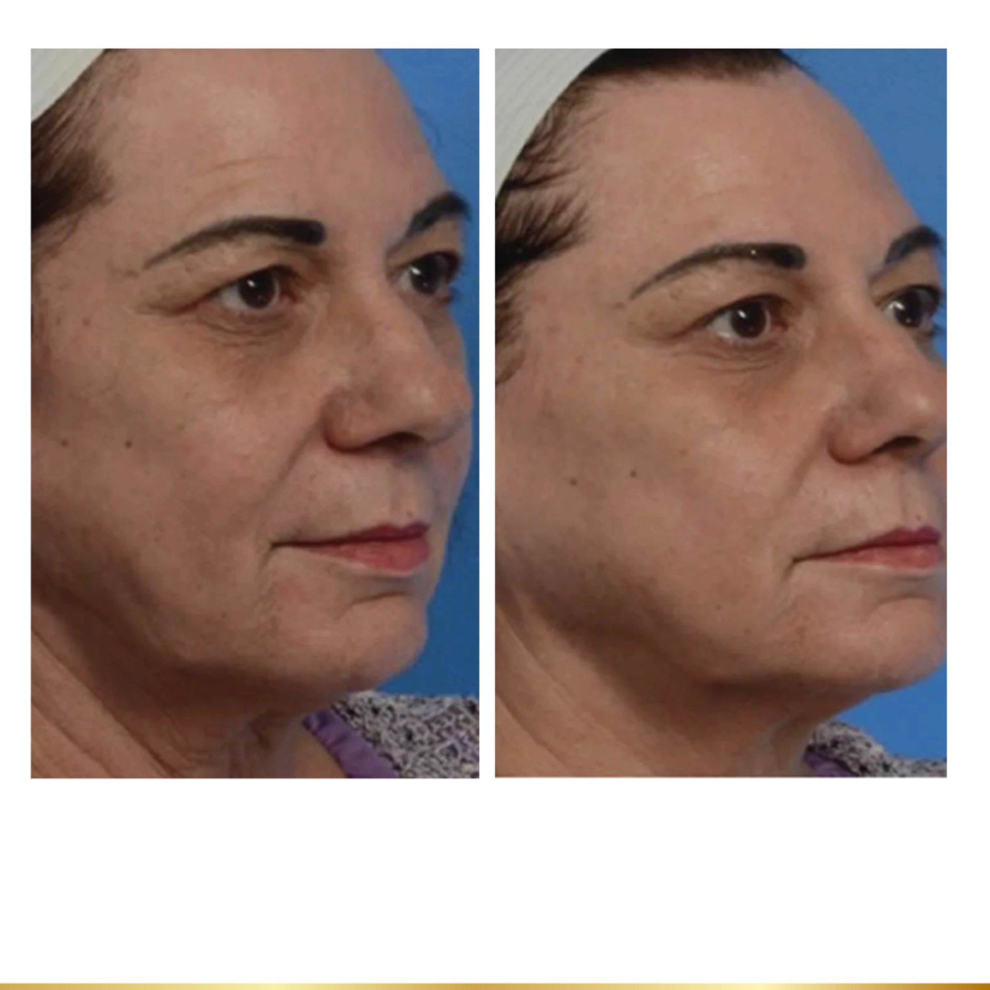 Before and after aesthetic treatment highlighting firmer skin, refined contours, and smoother texture.