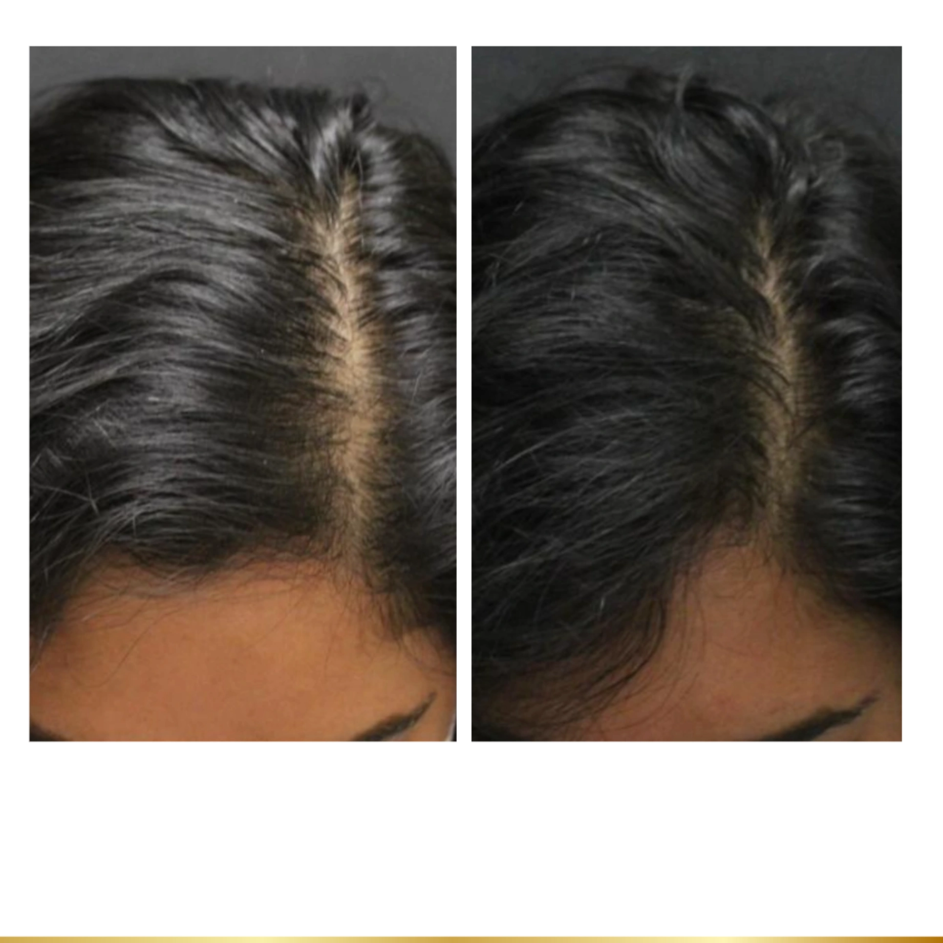Female scalp improvement after hair regrowth treatment for thinning hair.
